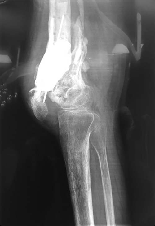 politrauma osteomielite 2