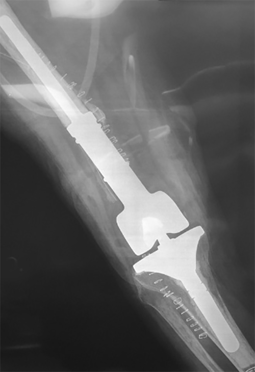 politrauma osteomielite 5